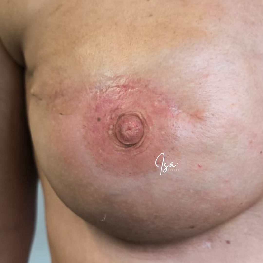 testimonio tatuaje reconstruccion