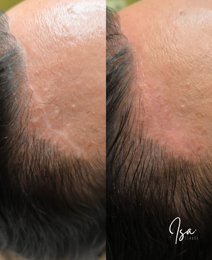 Camuflaje cicatrices de lifting facial