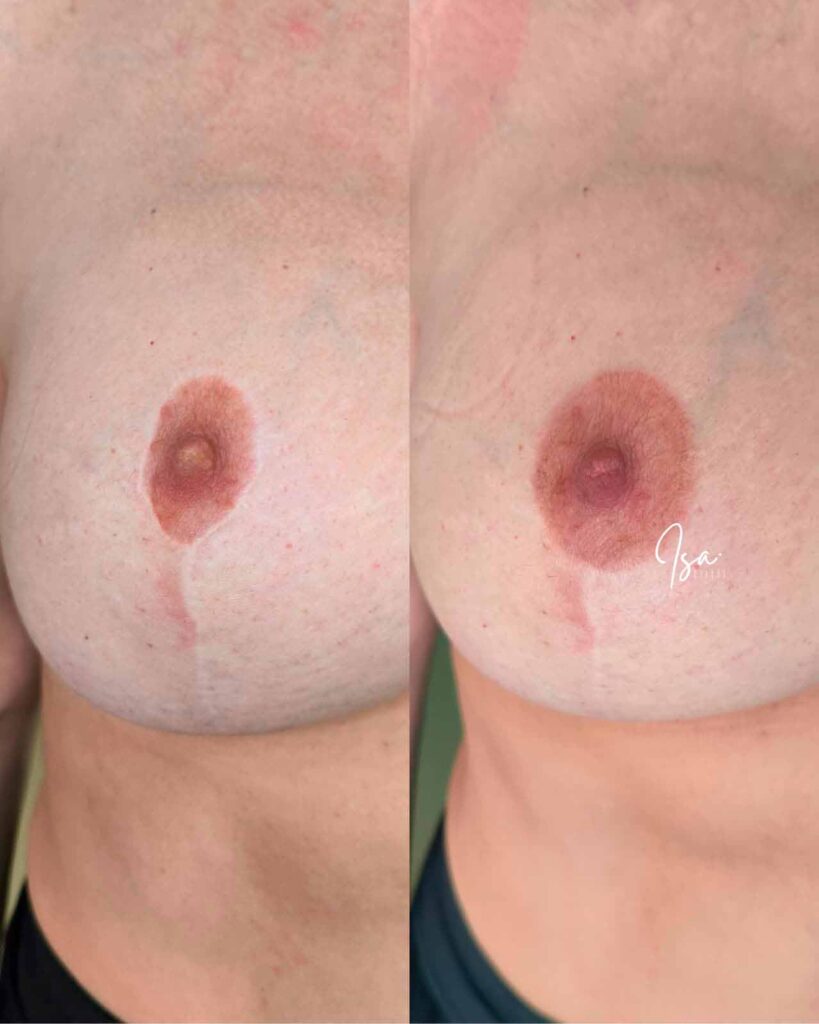 Camuflaje cicatriz areola post cirugía - Isa cercós