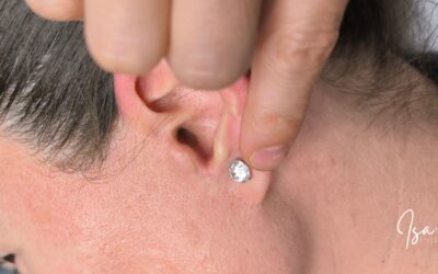 Camuflaje de cicatrices de lifting facial: cómo disimular las marcas de una cirugía con un resultado natural