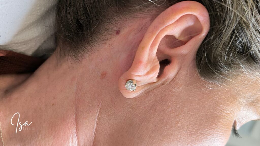 Camuflaje de cicatrices de lifting facial - Isa Cercós