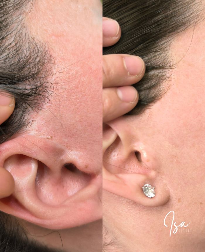 Camuflaje de cicatrices de lifting facial con tatuaje