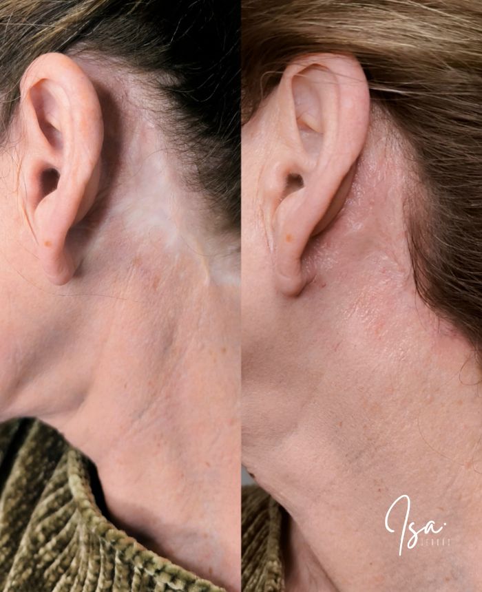Camuflaje de cicatrices faciales - Isa Cercós