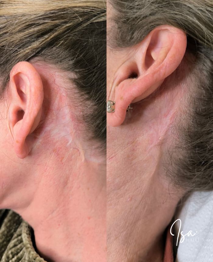 Camuflaje de cicatrices faciales con tatuaje - Isa Cercós
