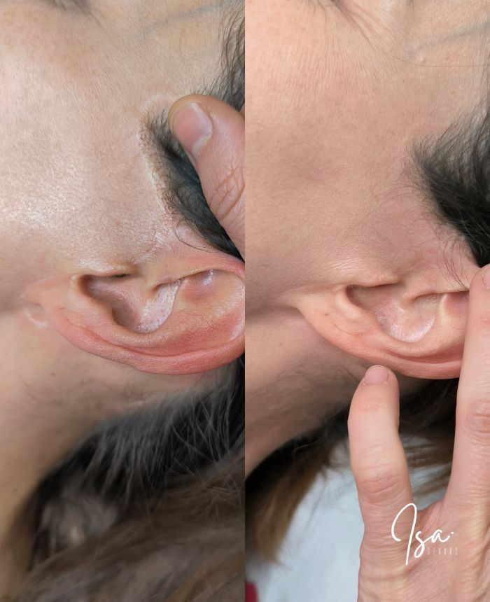Camuflaje de cicatrices faciales con tatuaje