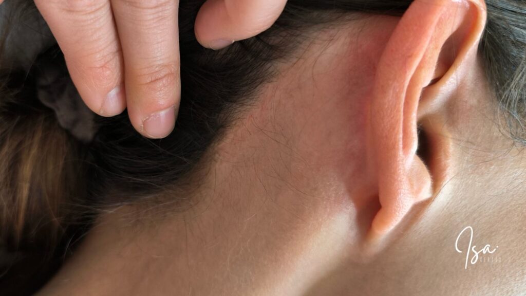 Camuflaje de cicatrices tras lifting facial - Isa Cercós
