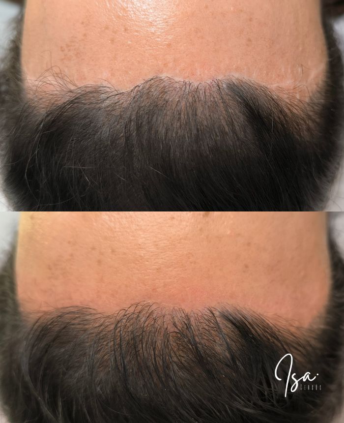 Camuflaje de cicatrices tras lifting facial