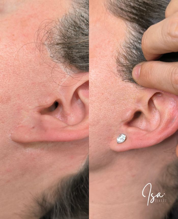 Camuflaje de cicatriz facial - Isa Cercós