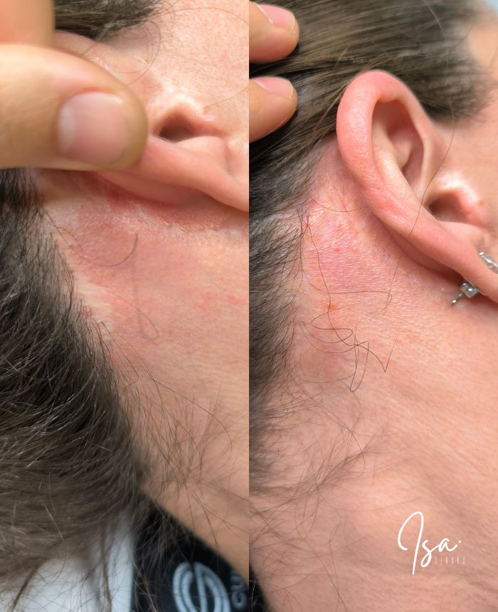 Camuflaje de cicatriz tras lifting facial - Isa Cercós