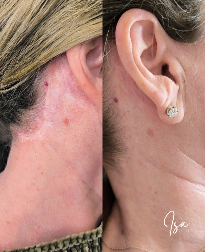 Camuflaje de cicatriz tras lifting facial