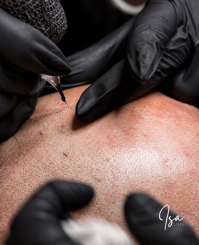 Micropigmentación capilar alopecia