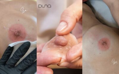 Prótesis de pezón o tatuaje areola-pezón: ¿qué opción elegir?