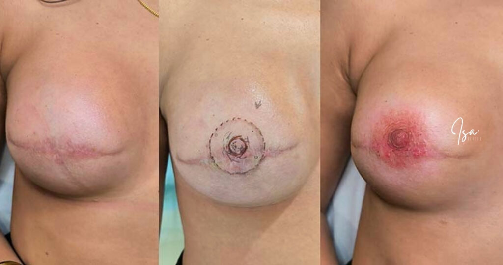 Reconstrucción mamaria - Tattoo Isa Cercós