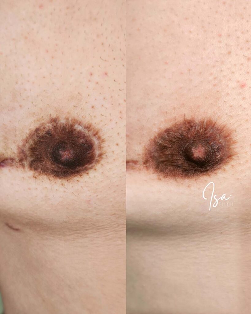 Resultado camuflaje cicatriz