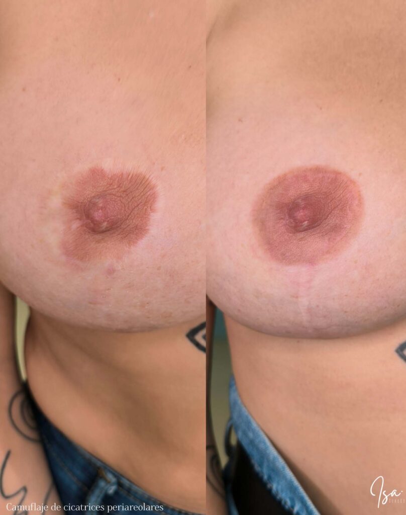 camuflajeperiareolar 1 isacercos