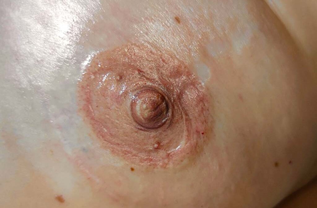 19 Octubre, Día Internacional del Cáncer de Mama