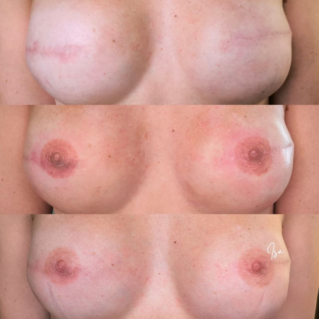 complejo areola-pezón1