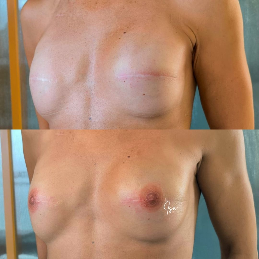 complejo areola-pezón3