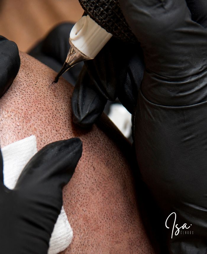 micro capilar - corregir alopecia