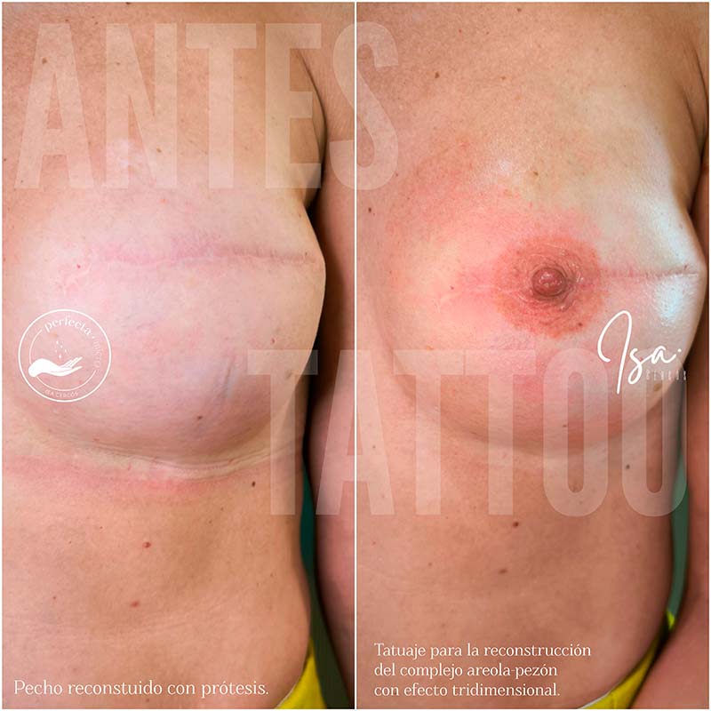 reconstrucción complejo areola pezón 3D