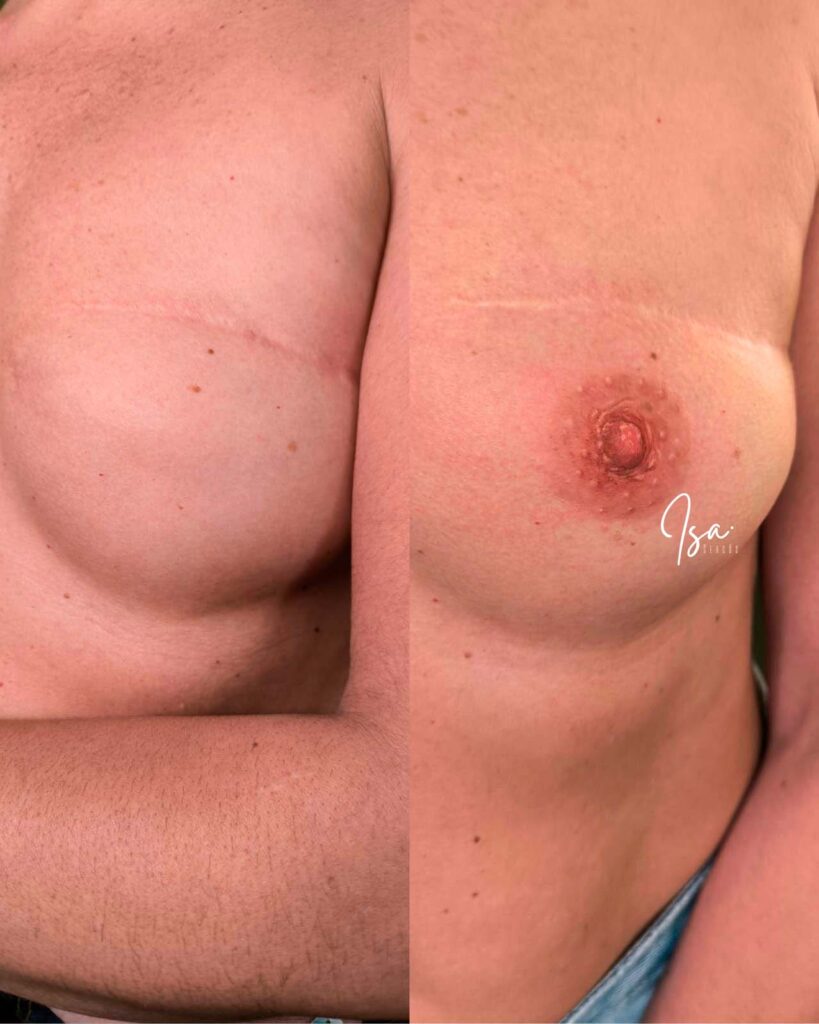 tatuaje areola después de la cirugía - Isa