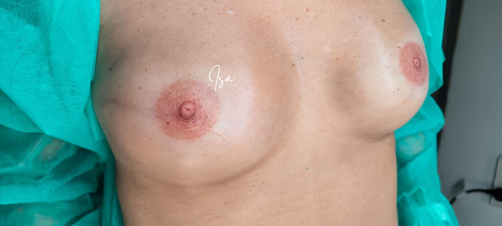 tatuaje areola-pezón cancer de mama.