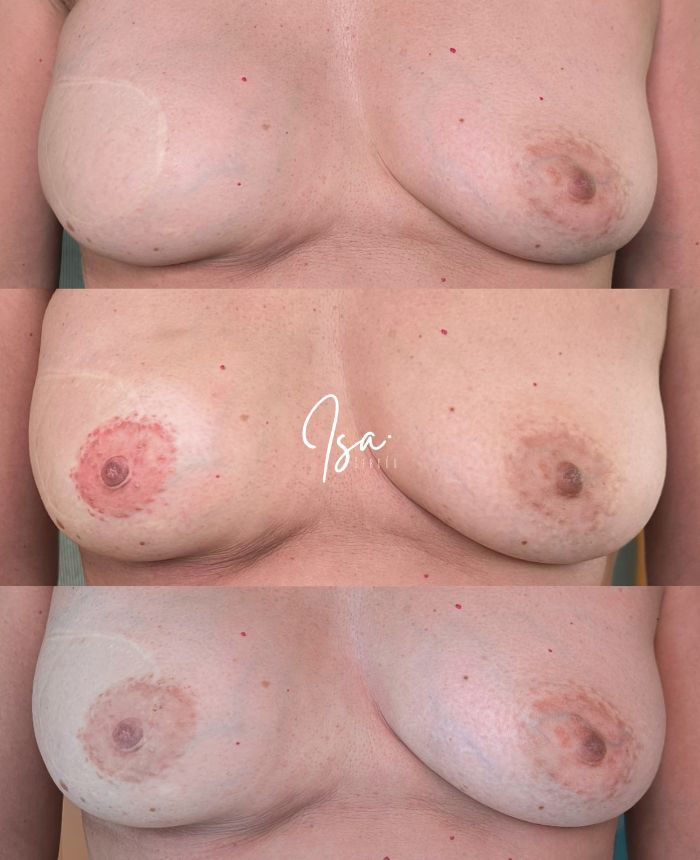 tatuaje areola pezón - mastectomía - Isa Cercós