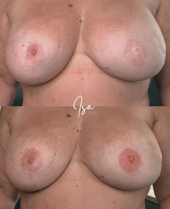 tatuaje areola-pezón - reconstrucción de mamas